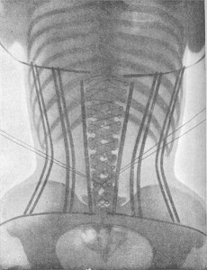 461px-Padiographie_du_corsetLigne(dos)